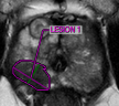 ברכיתרפיה מונחית על ידי מיזוג תהודה מגנטית (MRI) ועל-קולית (TRUS).