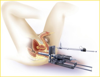 ברכיתרפיה מונחית על ידי מיזוג תהודה מגנטית (MRI) ועל-קולית (TRUS).